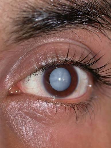 Eye with a cataract