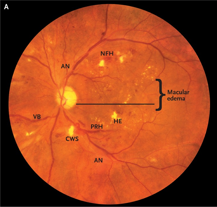 Retina photograph with macular edema