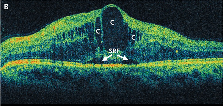 OCT scan of macular edema