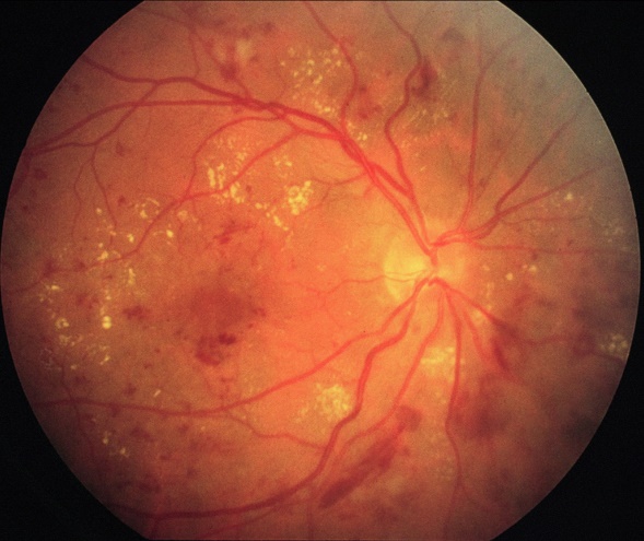Retina with diabetic retinopathy