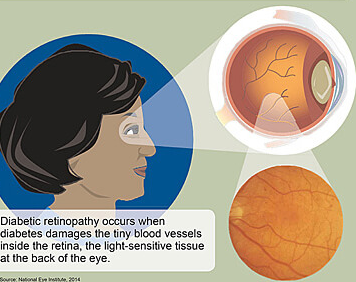Diabetic retinopathy occurs when diabetes damages the tiny blood vessels inside the retina (National Eye Institute, 2014)