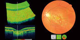 OCT retina scan