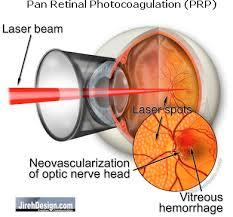Pan retinal photocoagulation (PRP) laser treatment