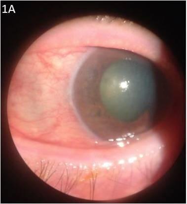 Eye affected by glaucoma