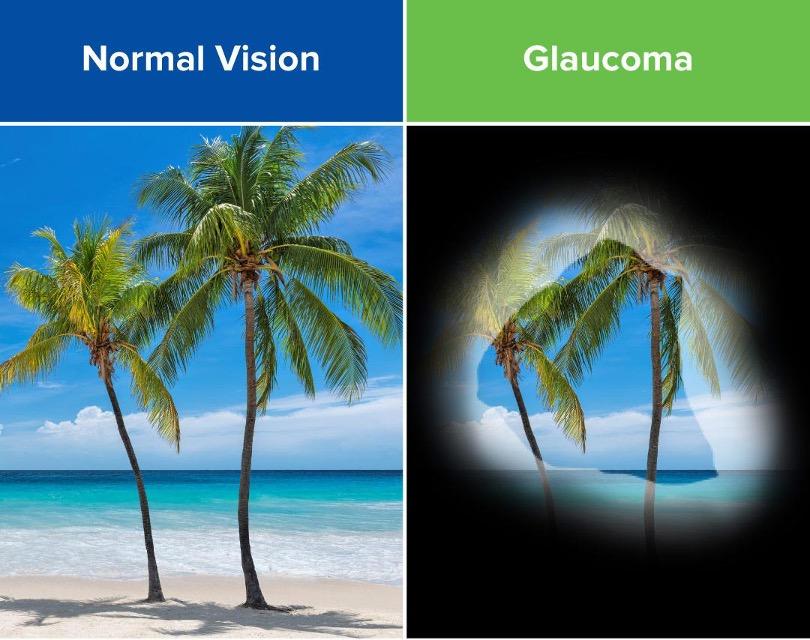 Normal vision compared with glaucoma vision