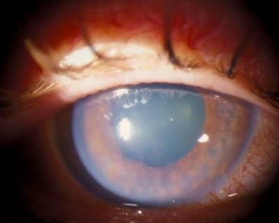 Eye showing glaucoma symptoms